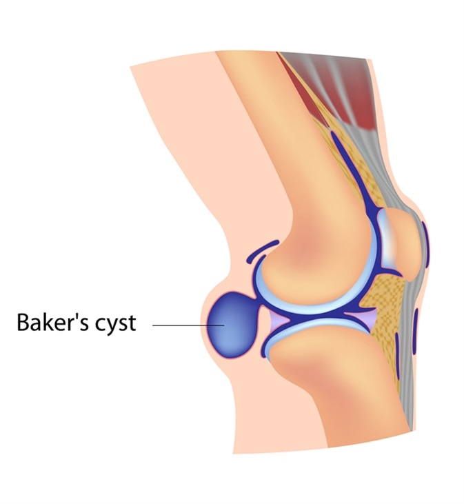 Baker's cyst. Image Credit: Alila Medical Media / Shutterstock